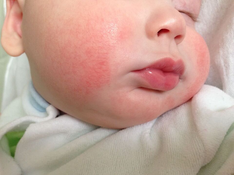 Tārpu pazīme bērnam ir alerģiska nātrene